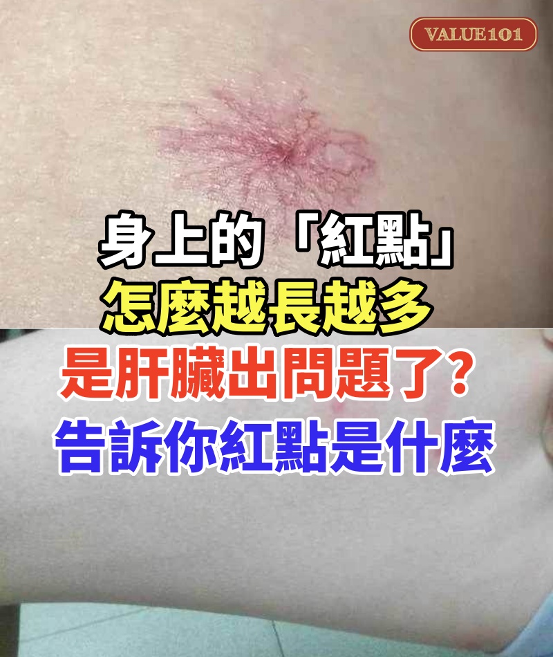 身上的「紅點」怎麼越長越多,是肝臟出問題了?告訴你紅點是什麼