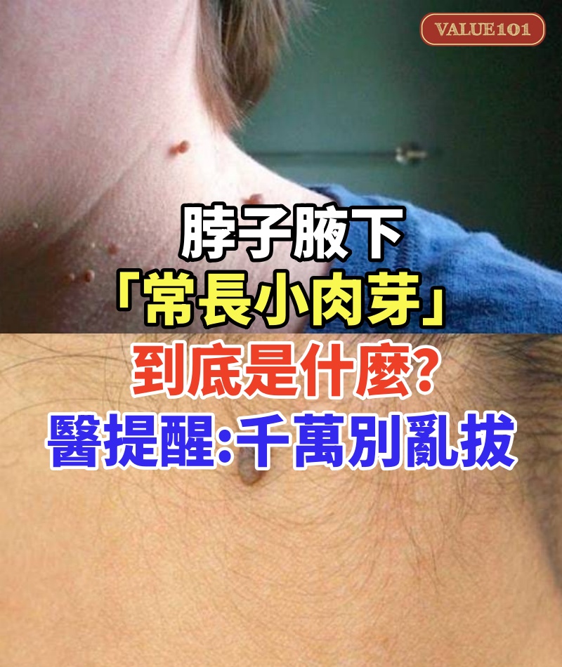 脖子、腋下「常長小肉芽」到底是什麼?醫提醒「千萬別亂拔」:4癥狀要注意