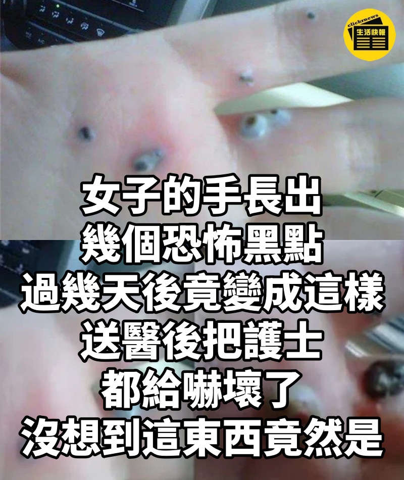 女子的手長出幾個恐怖黑點,過幾天後竟變成這樣!送醫後把護士都給嚇壞了,沒想到這東西竟然是